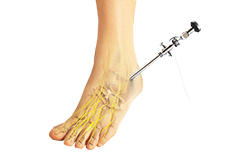 Ankle Arthroscopy