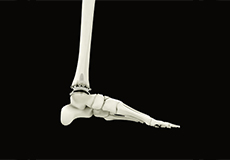 Ankle Joint Replacement