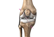 Arthroscopic Reconstruction of the Knee for Ligament Injuries