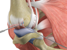 Rotator Cuff Repair