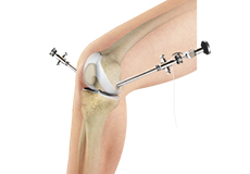 Knee Arthroscopy