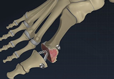 Minimally Invasive Bunion Surgery