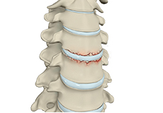 Fractures of the Spine