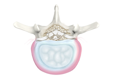 Degenerative Disc Disease