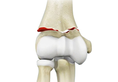 Elbow Fractures