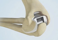 Total Elbow Replacement