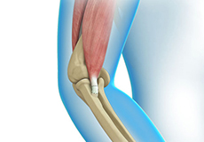 Elbow Tendon and Ligament Repair