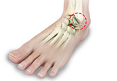 Foot and Ankle Arthritis