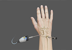 Wrist Arthroscopy