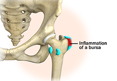 Hip Bursitis