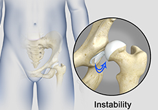 Hip Instability