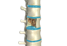 Spinal Infection