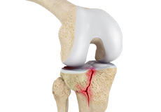Knee Fracture