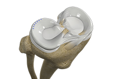 Meniscal Surgery