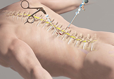 Minimally Invasive Spine Surgery