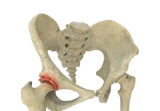 Osteoarthritis of the Hip