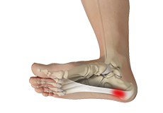 Plantar Fasciitis