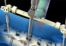 Robotic Spine Surgery