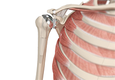 Shoulder Joint Replacement