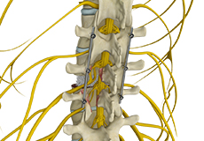 Spinal Fusion