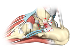 Ankle Sprain