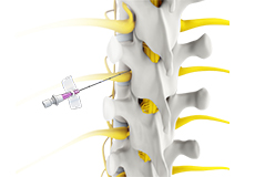 Transforaminal Epidural Steroid Injection