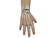 Wrist Joint Replacement