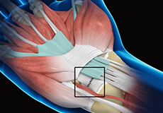 Wrist Ligament Reconstruction